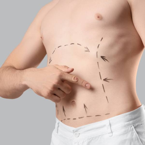 Abdominoplastia Abdominoplastia
