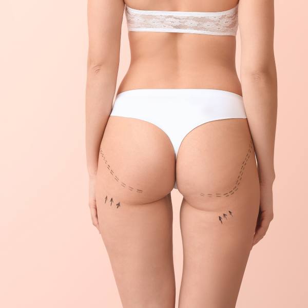 Aumento de glúteos Aumento de glúteos