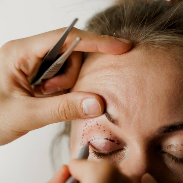 Blefaroplastia Blefaroplastia