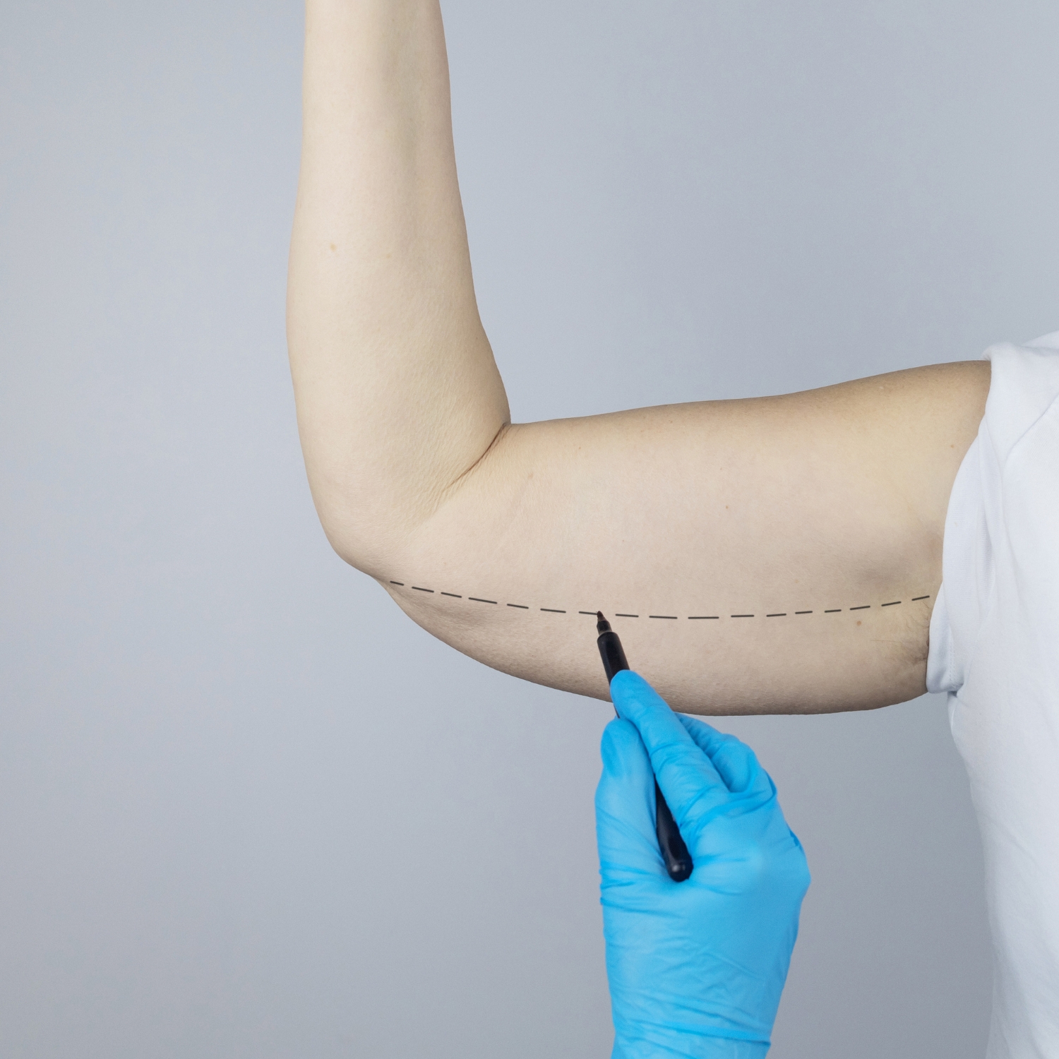 Lifting de brazos Lifting de brazos